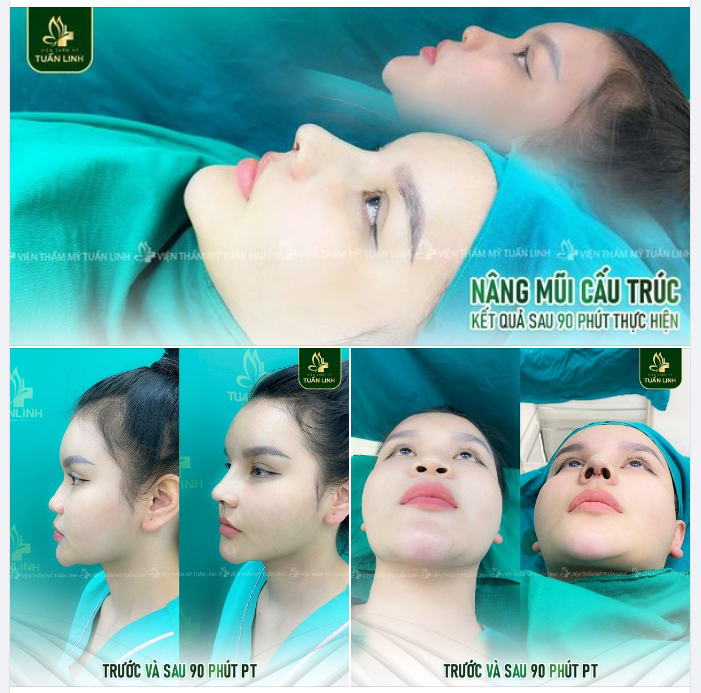 Chỉ với 3X Triệu - Và sau 1 tiếng 30 phút bạn sẽ có được dáng mũi này!!