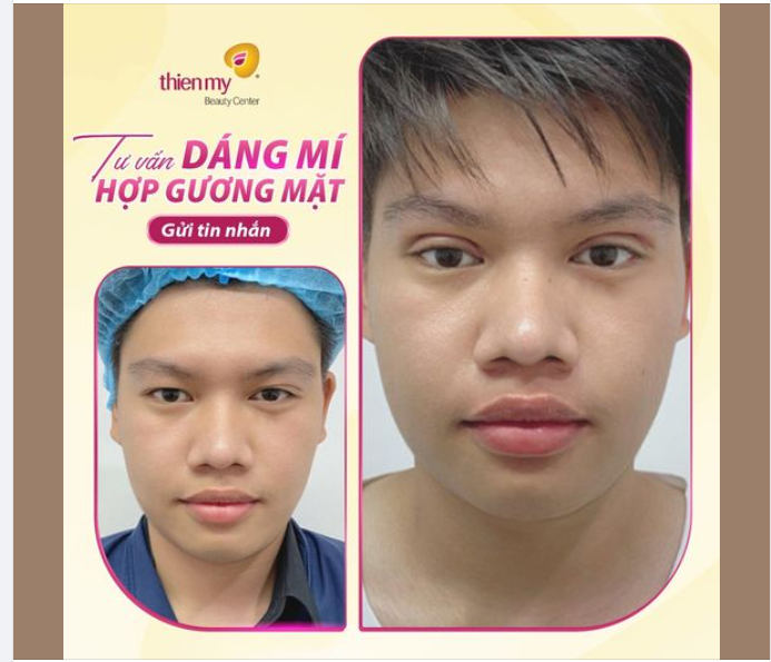 MÍ RÕ NÉT, NÂNG CẤP ĐỘ NAM TÍNH