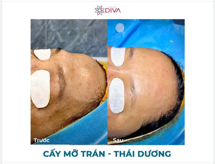 HÓP THÁI DƯƠNG, TRÁN - PHƯƠNG PHÁP NÀO ĐIỀU TRỊ TỐT NHẤT?