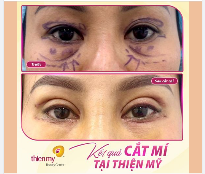 CẮT MÍ MẮT – NHÂN ĐÔI VẺ ĐẸP “CỬA SỔ TÂM HỒN”