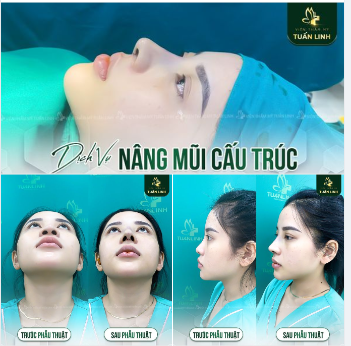 NÂNG MŨI SIÊU CẤU TRÚC GIẢM NGAY 10 TRIỆU 