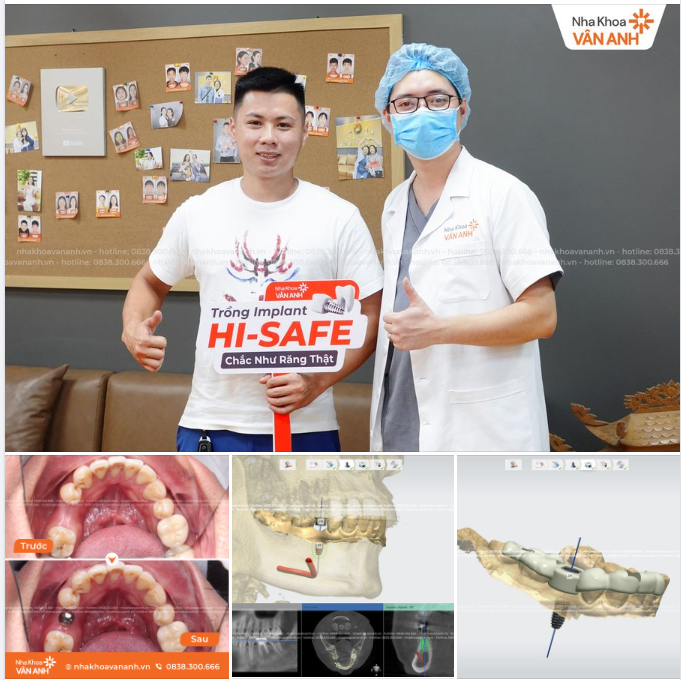 Hình ảnh dưới đây là kết quả phục hình răng mất cho anh Tiến bằng Công nghệ Hi-safe. Các bạn cùng theo dõi nhé!