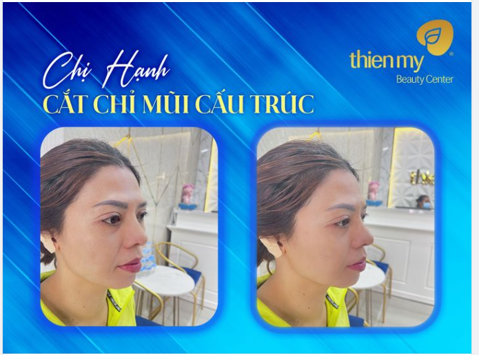 Feedback chiếc mũi cực phẩm của chị Hạnh với nâng mũi cấu trúc tại Viện Thẩm mỹ Thiện Mỹ