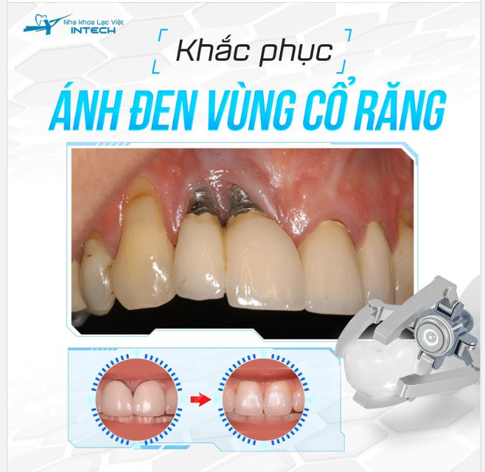 Ánh đen vùng cổ răng implant giờ đây đã có cách khắc phục