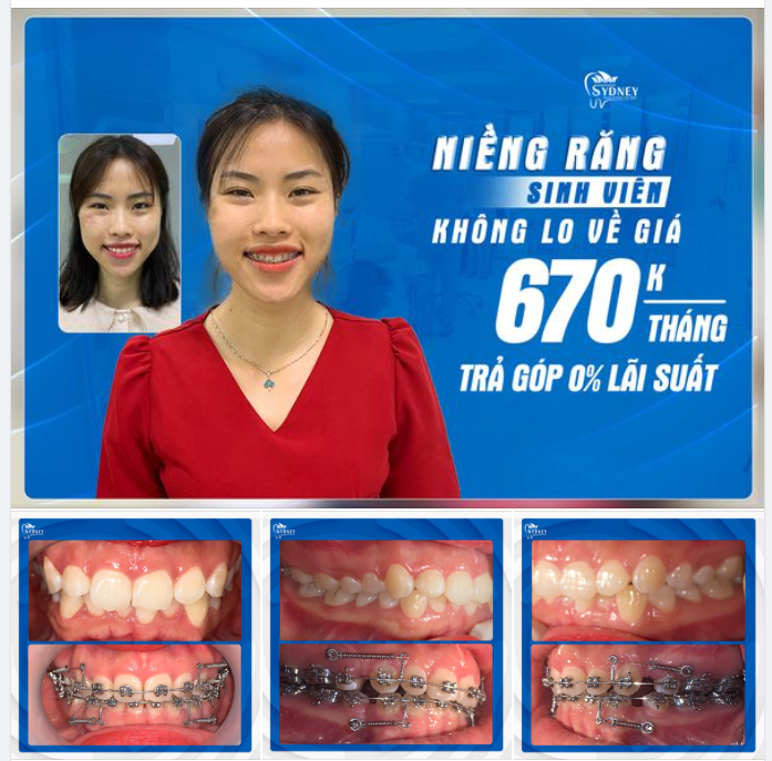 RĂNG ĐẸP CƯỜI XINH – CHẲNG NGẠI CHI PHÍ!