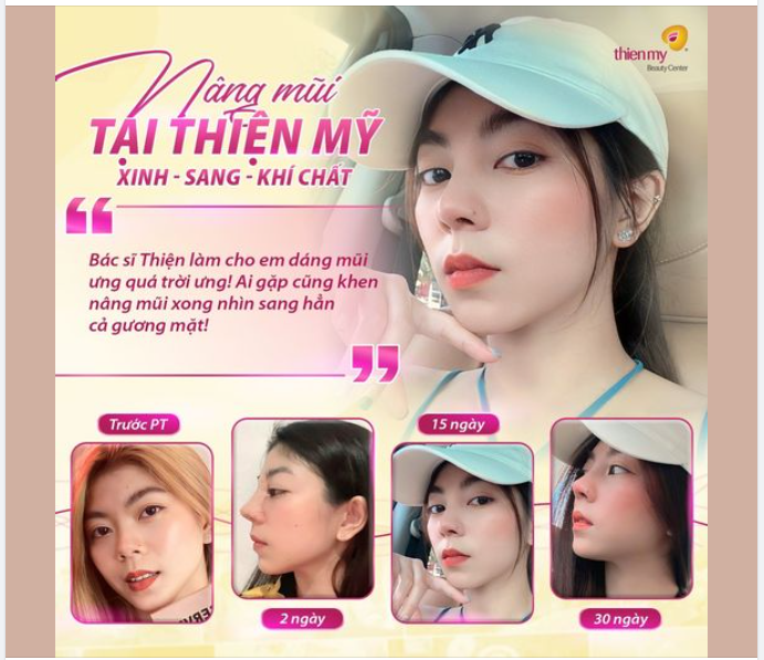 THAY DÁNG MŨI – TĂNG KHÍ CHẤT