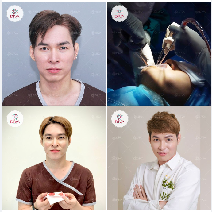 SAU TIÊM MỠ CẰM - TÁCH TÚI MỠ MÁ TRONG GƯƠNG MẶT ĐẸP CÂN ĐỐI, HÀI HÒA