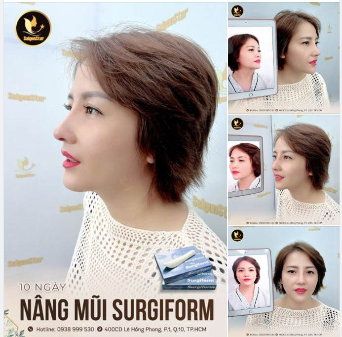10 NGÀY NÂNG MŨI CẤU TRÚC | KH: HỨA THU CÚC