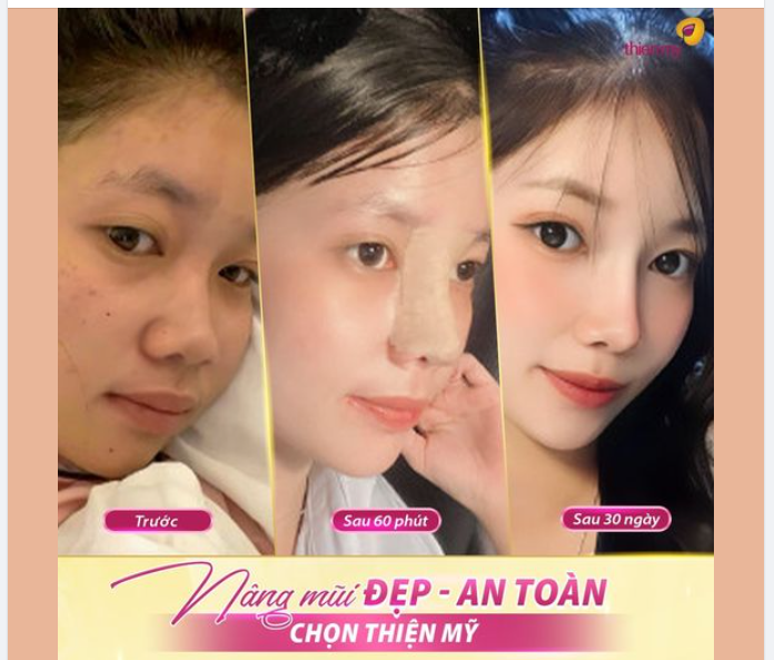 Chiếc mũi thấp, đầu mũi hếch khiến chị Tuyết Trinh gặp nhiều trắc trở trong công việc, nhưng vì sợ đau mà chị chần chừ mãi không dám nâng mũi.