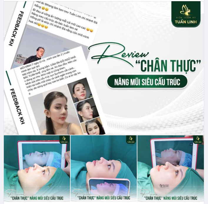 NÂNG MŨI SIÊU CẤU TRÚC VÀ NHỮNG REVIEW CHÂN THỰC TỪ KHÁCH HÀNG!!