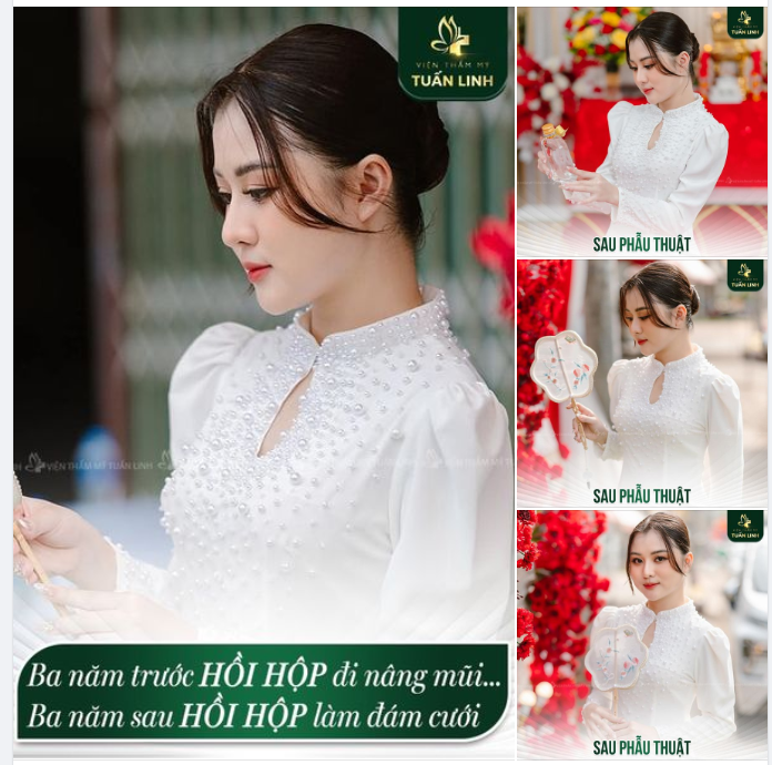 Nàng dâu xinh đẹp nhà Tuấn Linh!! Cách đây 3 năm cô nàng P.T đã lựa chọn tin tưởng Tuấn Linh để làm lại chiếc mũi của mình.