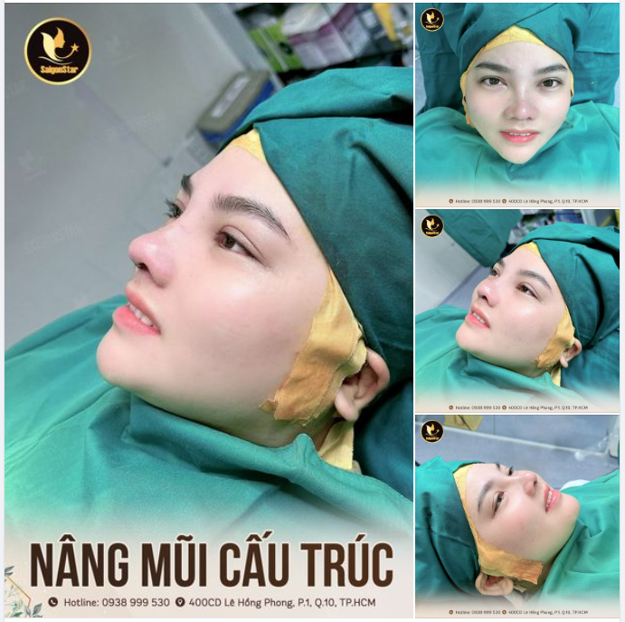Tạm biệt mũi thấp tẹt, ngắn hếch chỉ sau 60 phút nâng mũi cấu trúc. Dáng mũi xinh, xịn như thế này chị em có ưng không nào?