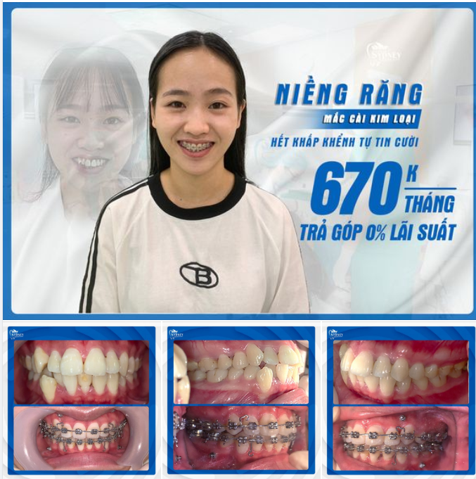 SIÊU HOT - THĂNG HẠNG NỤ CƯỜI CHỈ CẦN CHI 670K/THÁNG