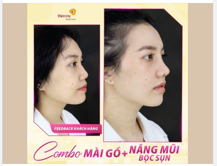 Feedback KH thực hiện combo mài gồ + Nâng mũi bọc sụn tại Thiện Mỹ.