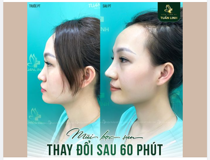Nâng mũi bọc sụn thay đổi sau 60 phút!!