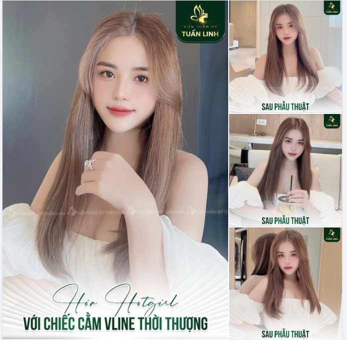 ĐẸP TỰA HOTGIRL NHỜ CHIẾC CẰM VLINE THỜI THƯỢNG 