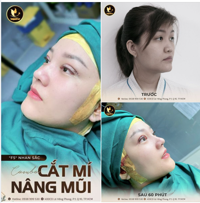 Người đẹp vì lụa  – Mũi, mí đẹp thì nhờ bác sĩ Hoạt