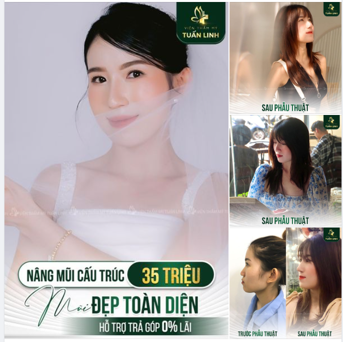 NÂNG MŨI CẤU TRÚC - 35 TRIỆU - GIÁ TRỌN GÓI