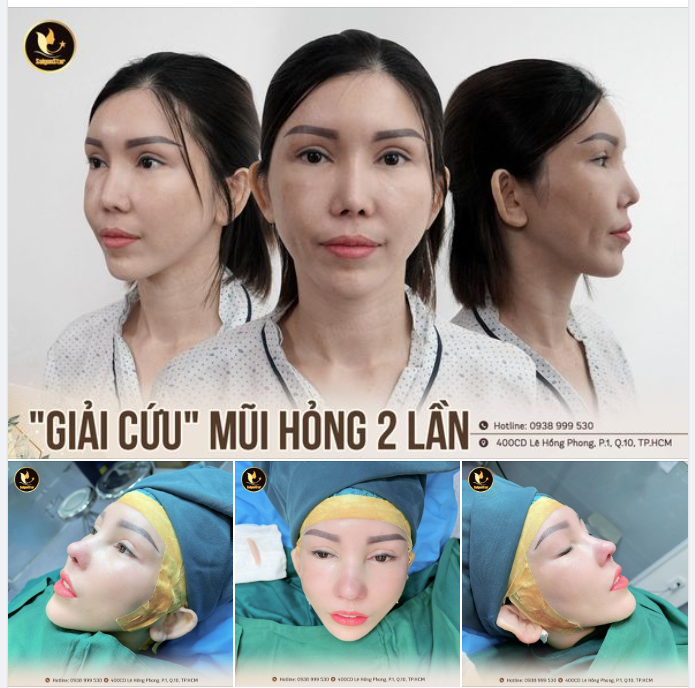 DR. HOẠT GIẢI CỨU MŨI HỎNG 2 LẦN