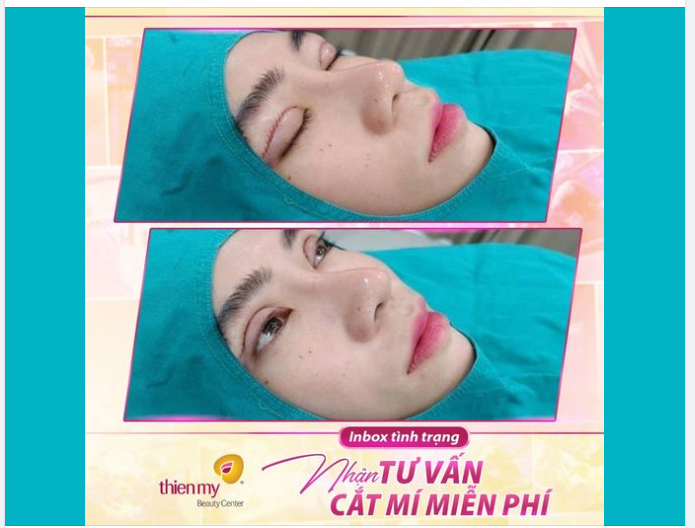 Một ca cắt mí "đáng đồng tiền bát gạo"