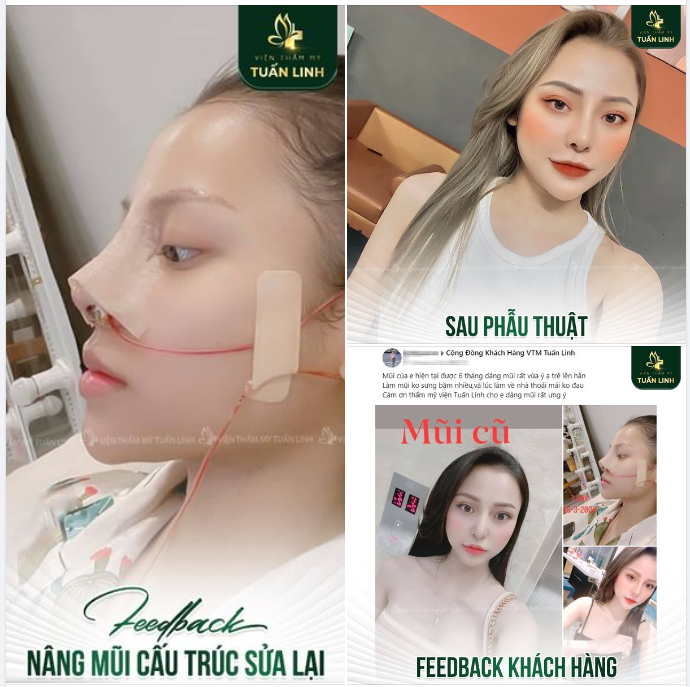 Feedback NÂNG MŨI SAU 6 THÁNG - Rất ưng ý 