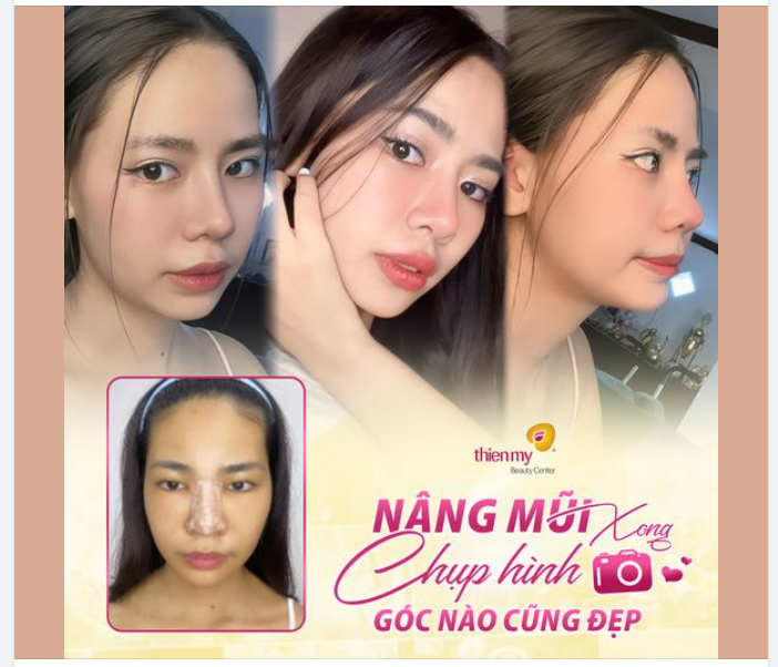Quá trời nhức cái nách với chiếc mũi 30 ngày tuổi, xinh hết nước chấm. Làm mũi xong chụp hình góc nào cũng sang cũng xịn!