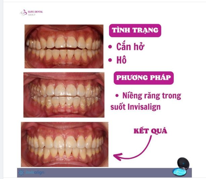 TÌNH TRẠNG: CẮN HỞ, RĂNG CHÌA, HÔ PHƯƠNG PHÁP ĐIỀU TRỊ: NIỀNG RĂNG TRONG SUỐT INVISALIGN