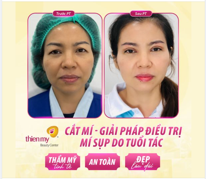 CẮT MÍ – KHÔI PHỤC VẺ ĐẸP CHO ĐÔI MẮT