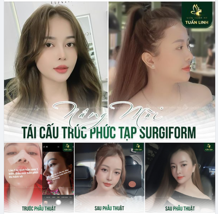 Chọn địa chỉ nâng mũi uy tín để làm một lần có ngay chiếc mũi bền đẹp an toàn .