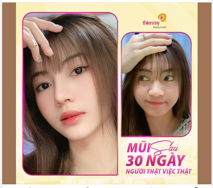 Nhan sắc xinh đẹp "hết nước chấm" sau 30 ngày nâng mũi của cô nàng Thúy Vân.