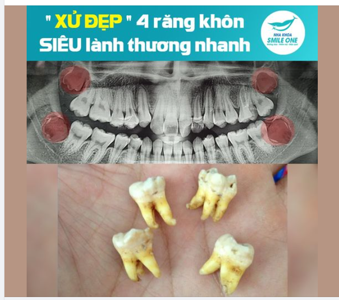"Xử đẹp" 4 răng khôn lành thương siêu nhanh!