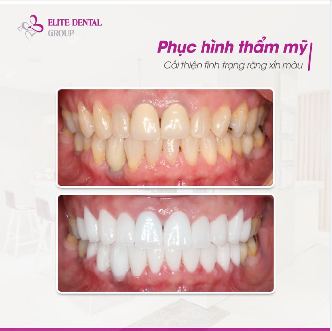 Thay đổi màu răng, tự tin cười rạng rỡ