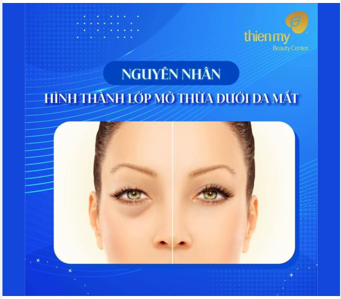 Nguyên nhân hình thành lớp mỡ thừa dưới da mắt