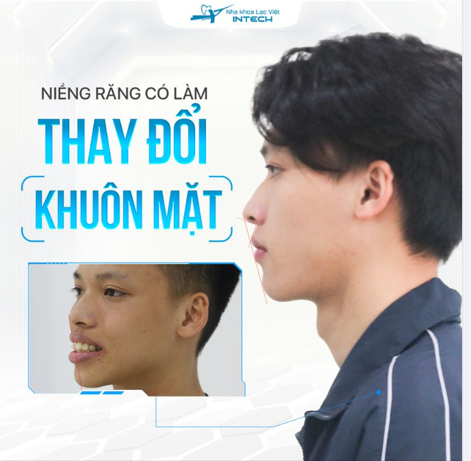Sự thật về niềng răng thay đổi khuôn mặt