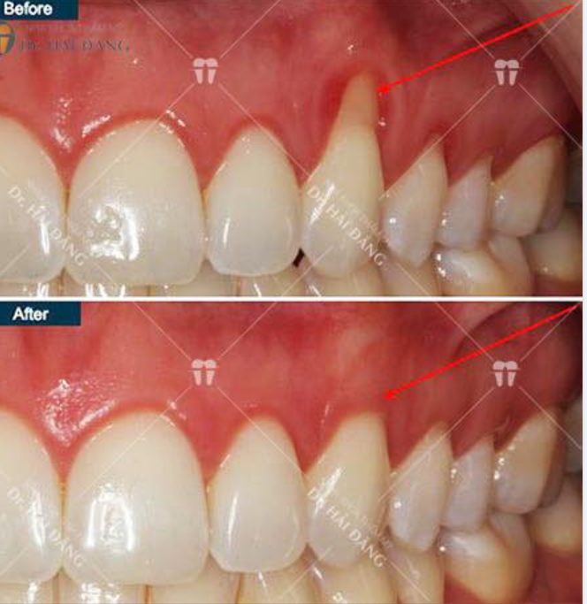 CÁCH CHỮA TỤT LỢI CHÂN RĂNG