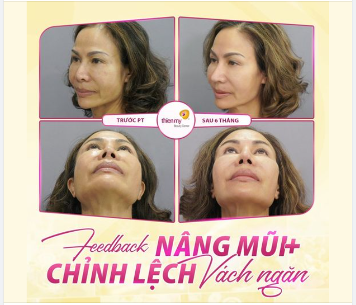 Nhìn kết quả chị khách hàng đã thực hiện dịch vụ nâng mũi kết hợp chỉnh lệch vách ngăn, có xứng đáng nhận điểm 10 không cả nhà?