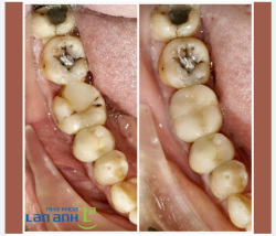 Răng sau khi chữa tủy có nên bọc răng sứ?