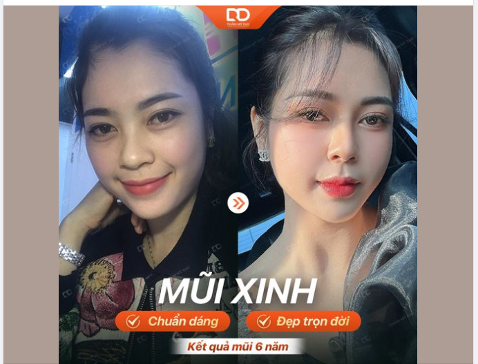 Mũi tự nhiên như thật sau 6 năm Nâng mũi Perfect Dform