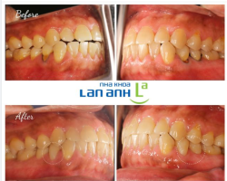  Hình ảnh ca điều trị trám mòn cổ chân răng tại Nha khoa Lan Anh - 61 Nguyễn Cơ Thạch - Khu Sala - Thành phố Thủ Đức