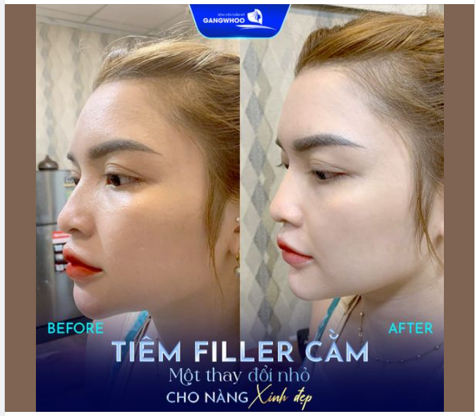 TIÊM FILLER CẰM 1 THAY ĐỔI NHỎ CHO NÀNG XINH ĐẸP