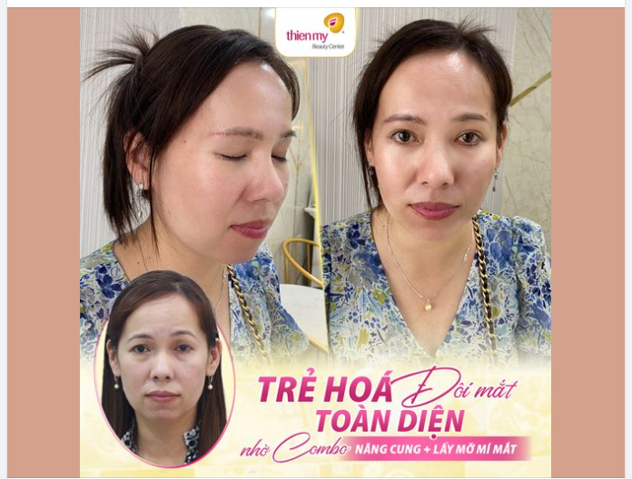 Mãn nhãn với thành quả sau 26 ngày thực hiện combo Nâng cung mày + lấy mỡ mắt dưới cho cô khách U50!