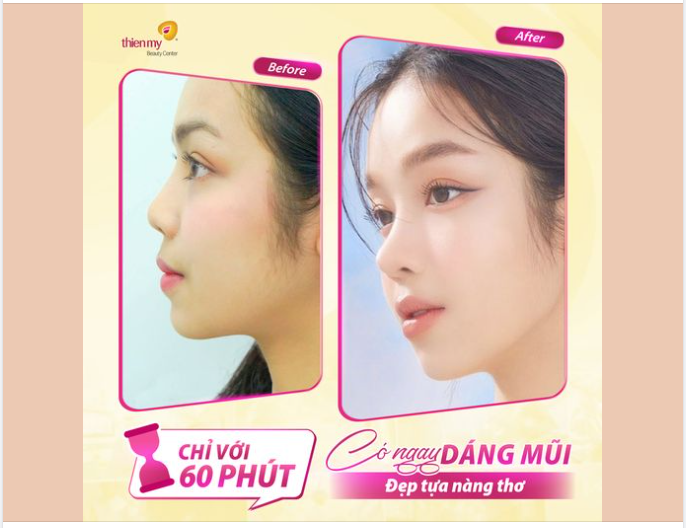 NÂNG MŨI TẠI THIỆN MỸ - MŨI ĐẸP TỰA NÀNG THƠ