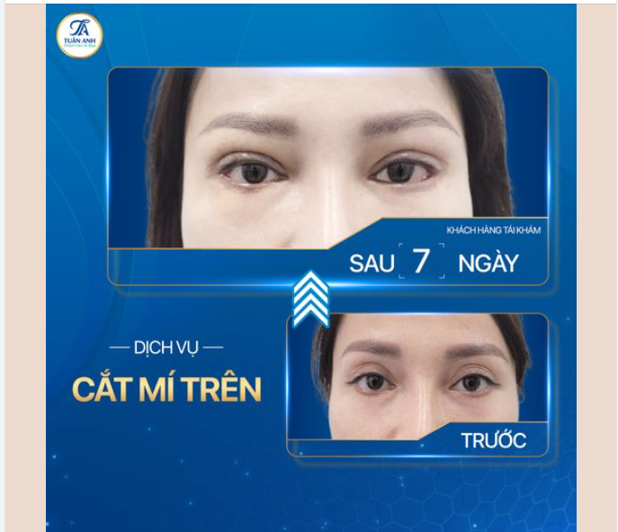 Việc cắt mí không chỉ đơn giản là giúp bạn thay đổi về ngoại hình mà còn là cách giúp bạn yêu bản thân hơn.