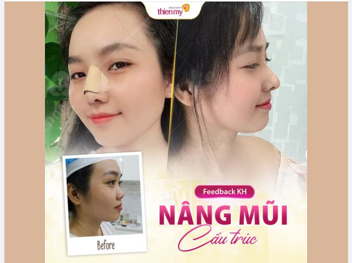 Chỉ cần sửa nhẹ cái mũi là nhan sắc thăng hạng vụt vụt, thật sự vậy sao?
