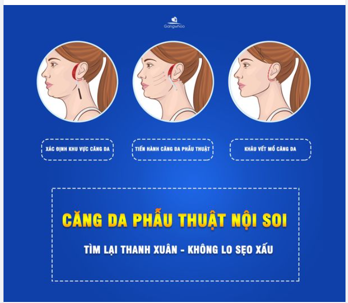 CĂNG DA PHẪU THUẬT NỘI SOI - TÌM LẠI THANH XUÂN KHÔNG LO SẸO XẤU