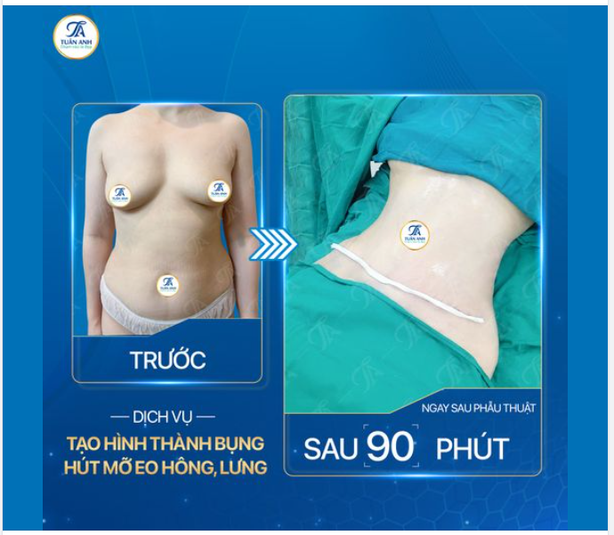Mẹ bỉm sữa 2 con được chồng đưa đến Thẩm mỹ Tuấn Anh để trùng tu lại body.