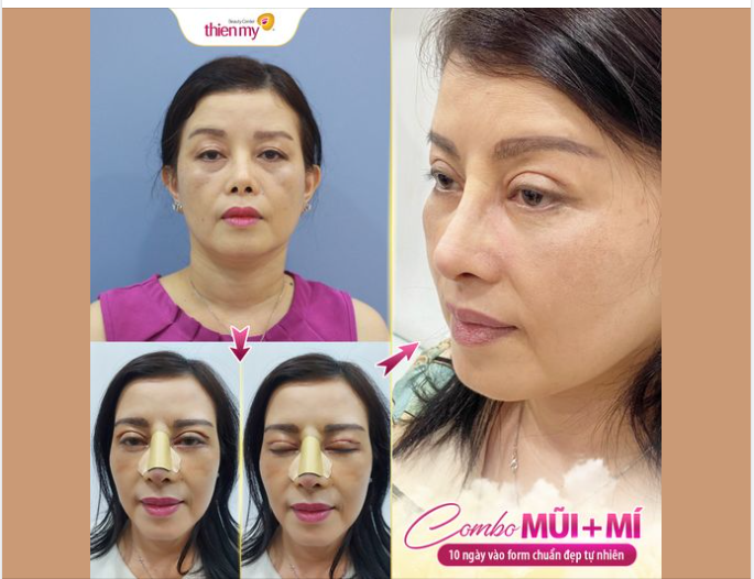 Tin nổi không: Thực hiện combo mũi + mí cùng lúc nhưng không sưng, không đau, không bầm.