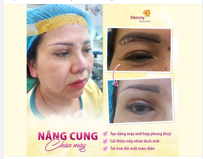 Úp 1 chiếc ảnh xịn xò khách hàng thực hiện nâng cung chân mày tại VTM Thiện Mỹ đây ạ!