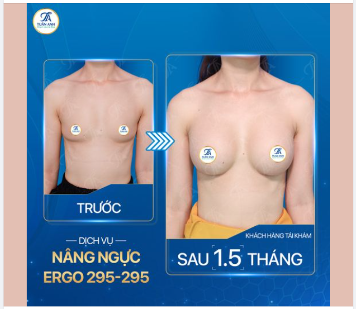 TRÌNH LÀNG SIÊU PHẨM NGỰC EGRO SIZE 295 CHO CHỊ KHÁCH HÀNG BAY TỪ ÚC VỀ VIỆT NAM NÂNG NGỰC
