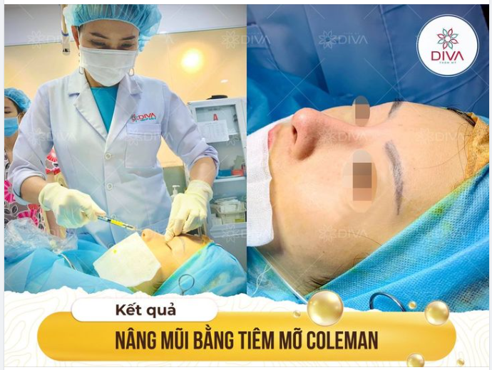 KẾT QUẢ THẨM MỸ TIÊM MỠ COLEMAN NÂNG CAO SỐNG MŨI